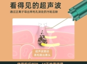 毛孔堵塞怎么清理全是闭口粉刺(HUAWEI HiLink超声波黑头铲美容仪器脸部毛孔清洁去粉刺吸出神器【包邮】)